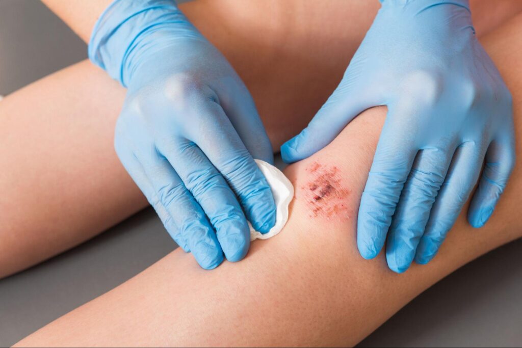 A doctor wearing blue medical gloves cleans a wound on a patient's knee to prevent the wound from becoming infected.
