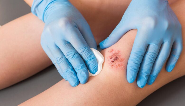 How Do You Know If a Wound is Infected?