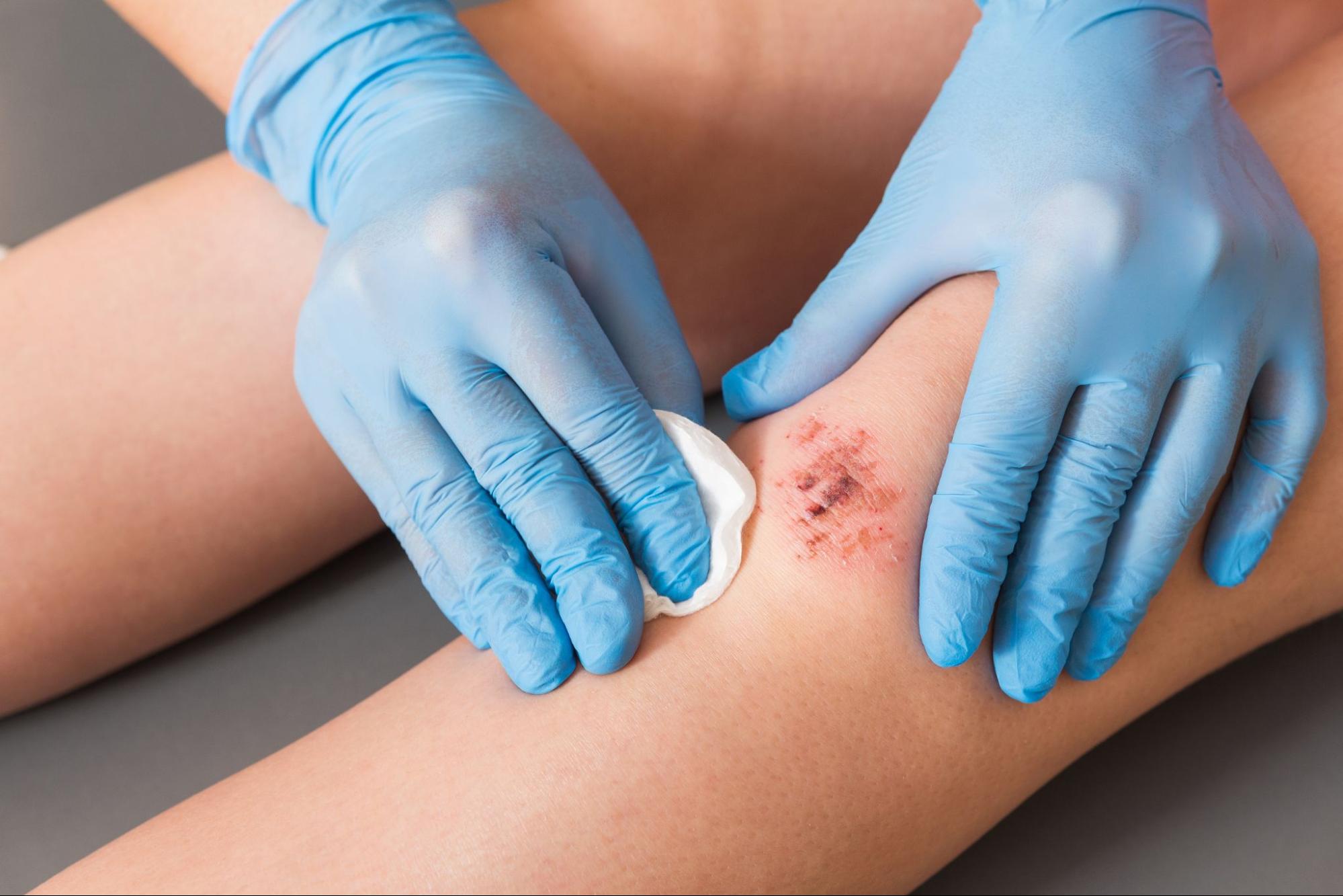 A doctor wearing blue medical gloves cleans a wound on a patient's knee to prevent the wound from becoming infected.