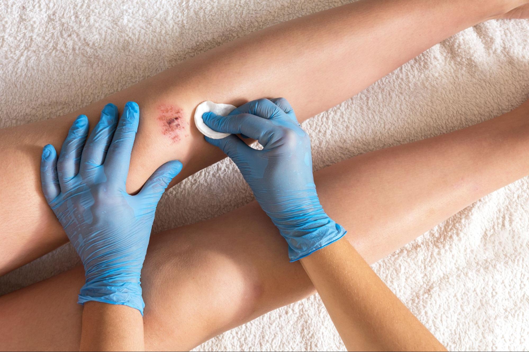A nurse wearing latex gloves treating a chronic wound on a knee.