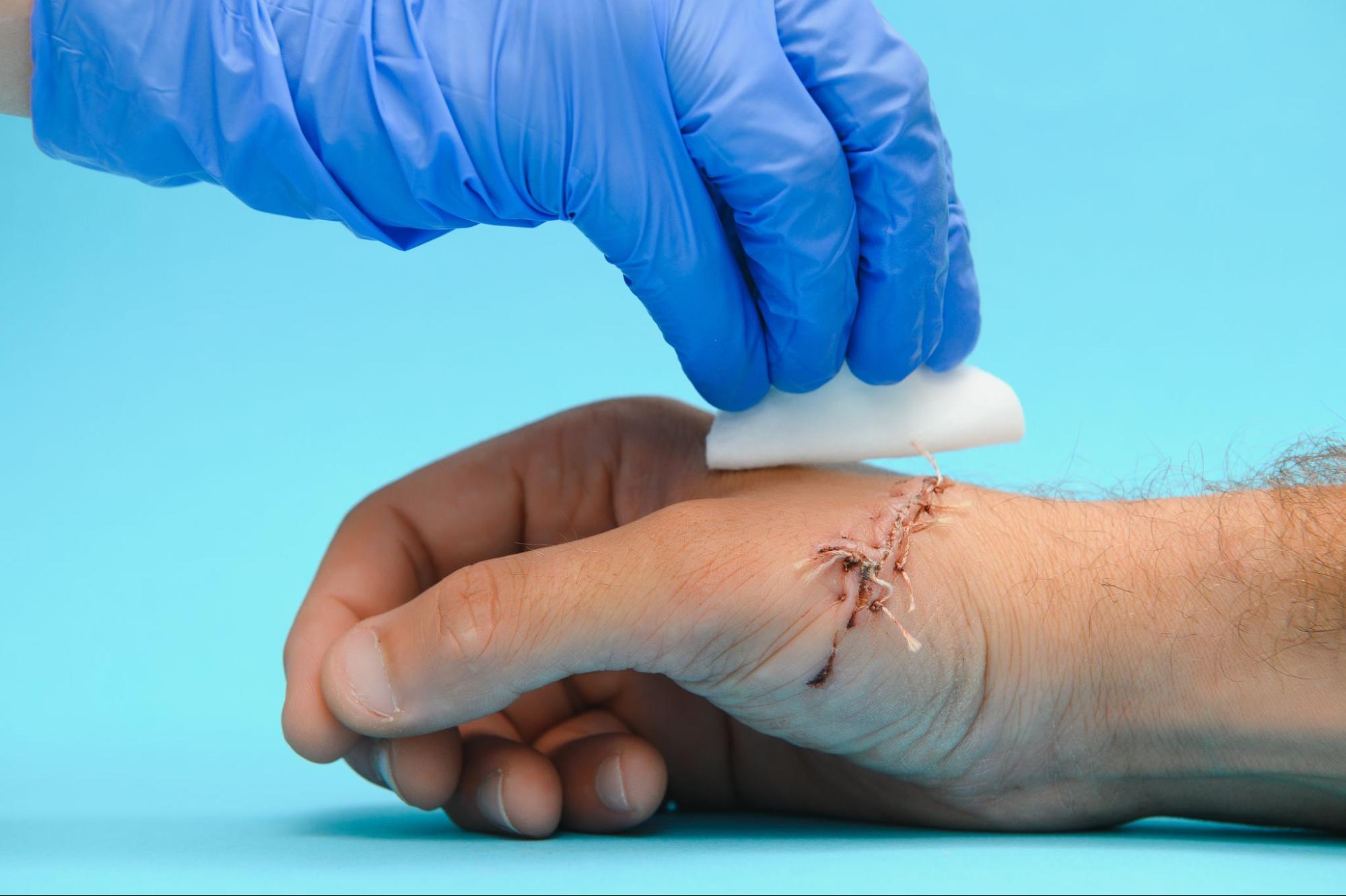 A wound expert cleaning a surgical wound with a cotton ball.