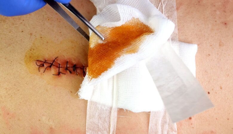 The Role of Debridement in Healing an Undermining Wound