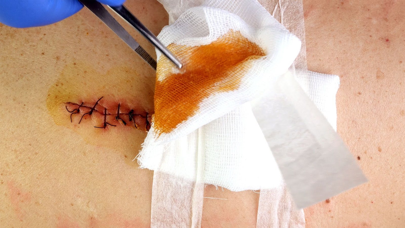 Close-up of stitched surgical sutures treated with betadine on an undermining wound during post-debridement care.