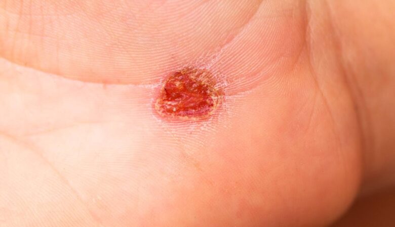 How to Identify a Tunneling Wound Early and Prevent Complications