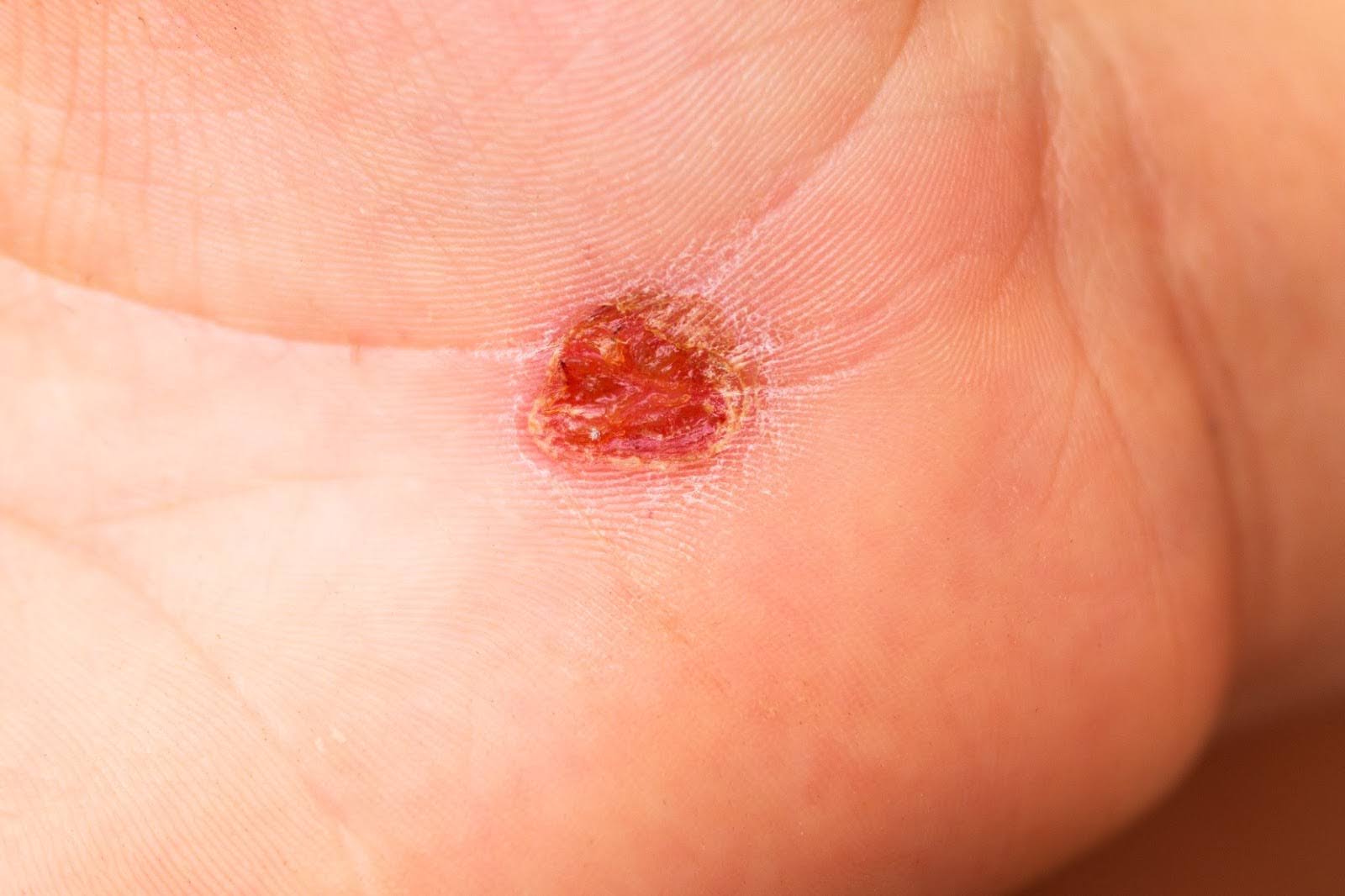 Close-up of an open abrasive wound on the hand with oozing serum.