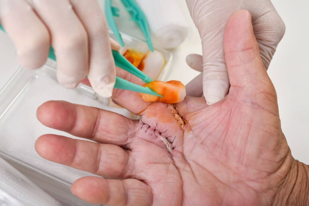 Hands applying betadine on stitched skin to prevent infection post-debridement.
