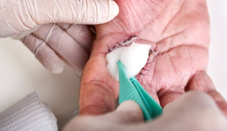 What is Wound Dehiscence and Why Does it Happen?