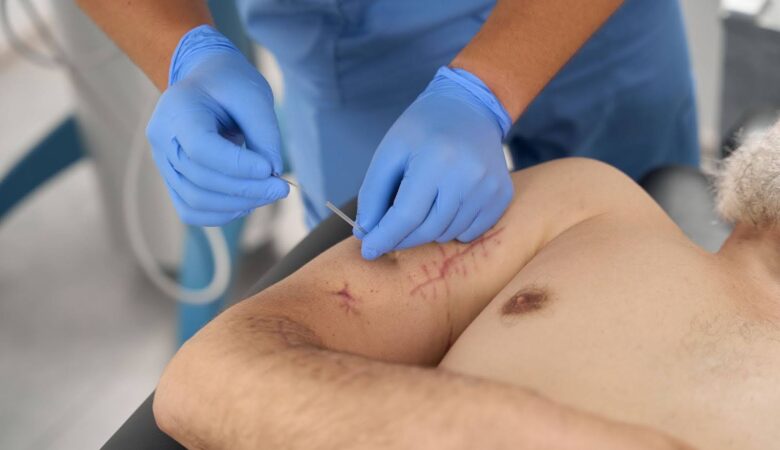 Early Signs of a Surgical Wound Infection You Shouldn’t Ignore