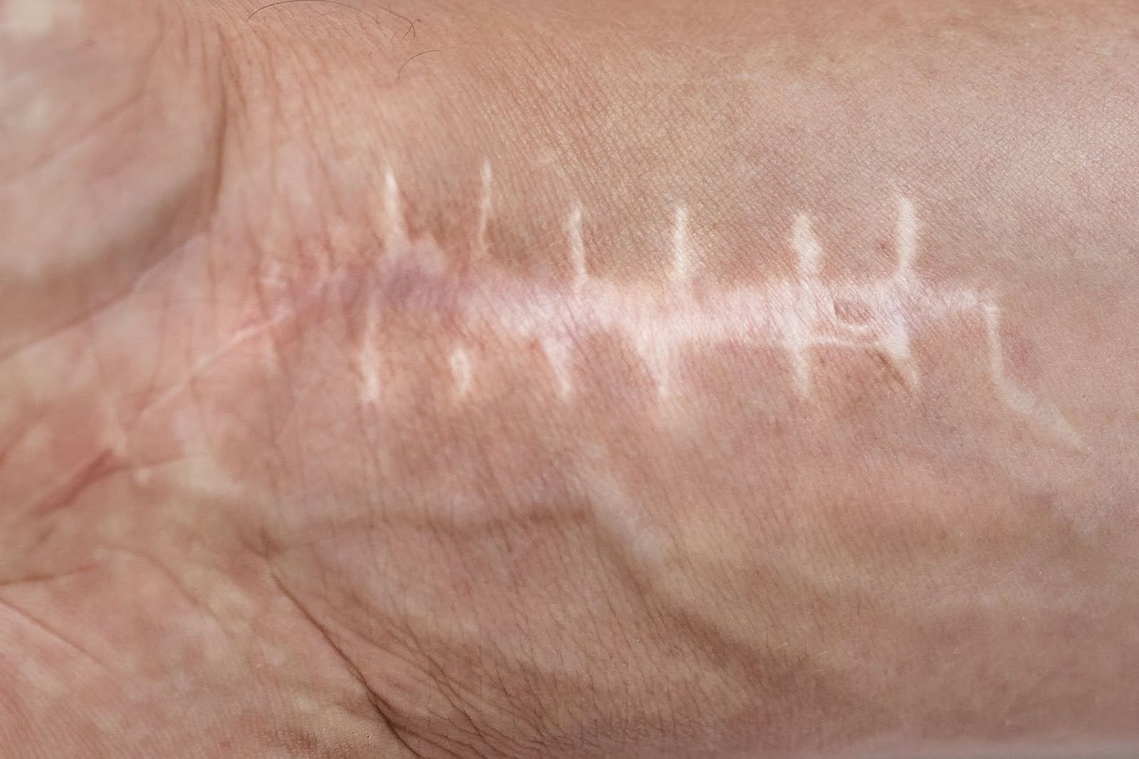 A healed wrist with surgical stitches, showing recovery phase relevant to regenerative treatment support.