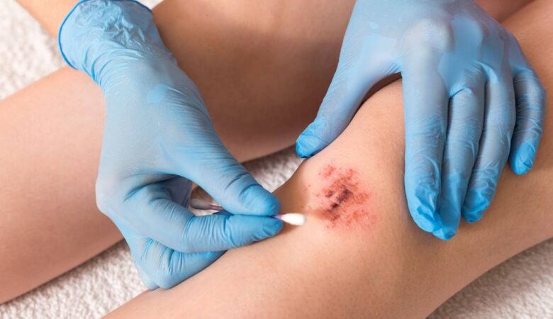 The Role of a Wound Care Specialist in Healing Chronic Wounds
