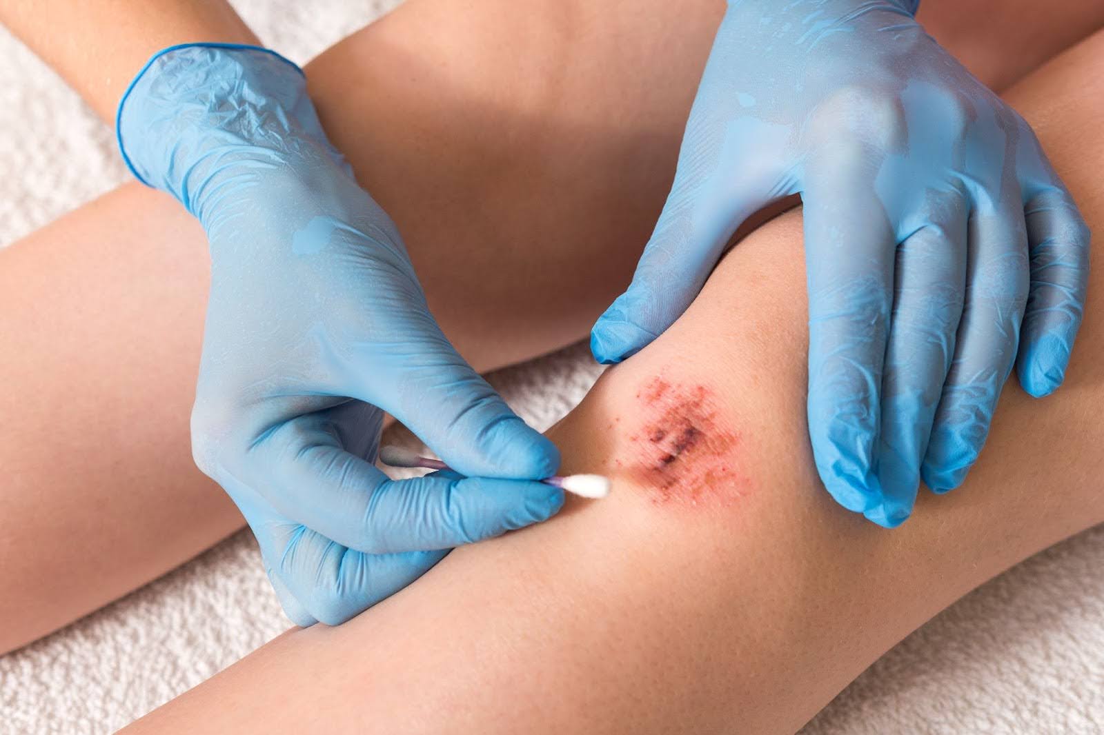 A close-up of a wound care specialist cleaning a bleeding knee wound with gloved hands.