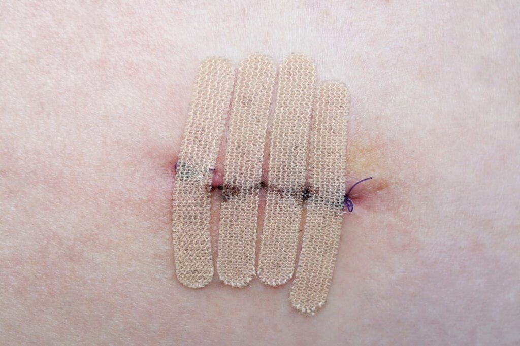 Healing skin biopsy site with visible suture stitches and wound closure strips.