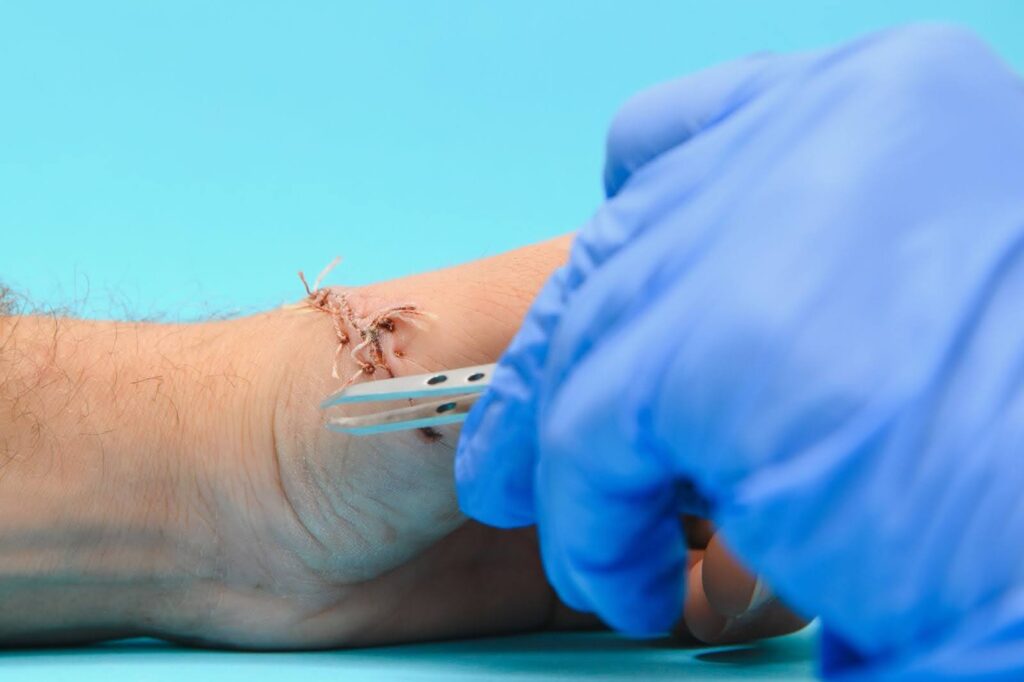 Close-up of a gloved medical professional inspecting hand sutures after surgery with sterile tweezers.