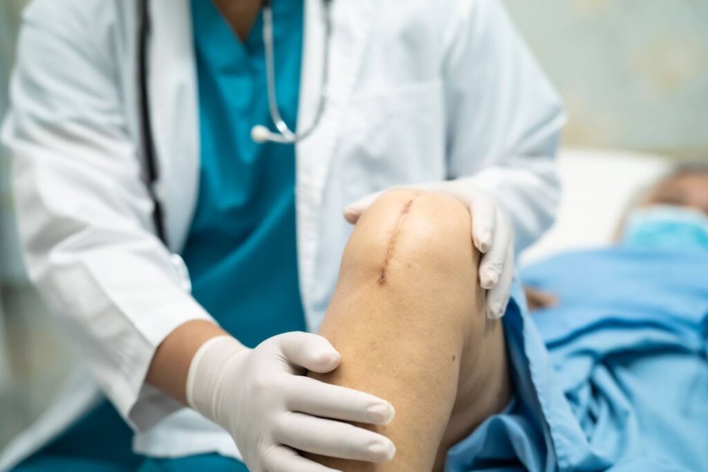 A woman showing surgical knee replacement scar with healing sutures.