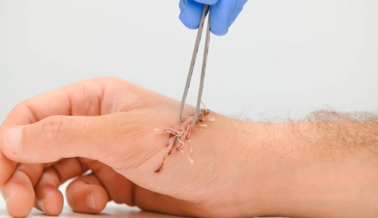 Common Risk Factors That Lead to Wound Dehiscence