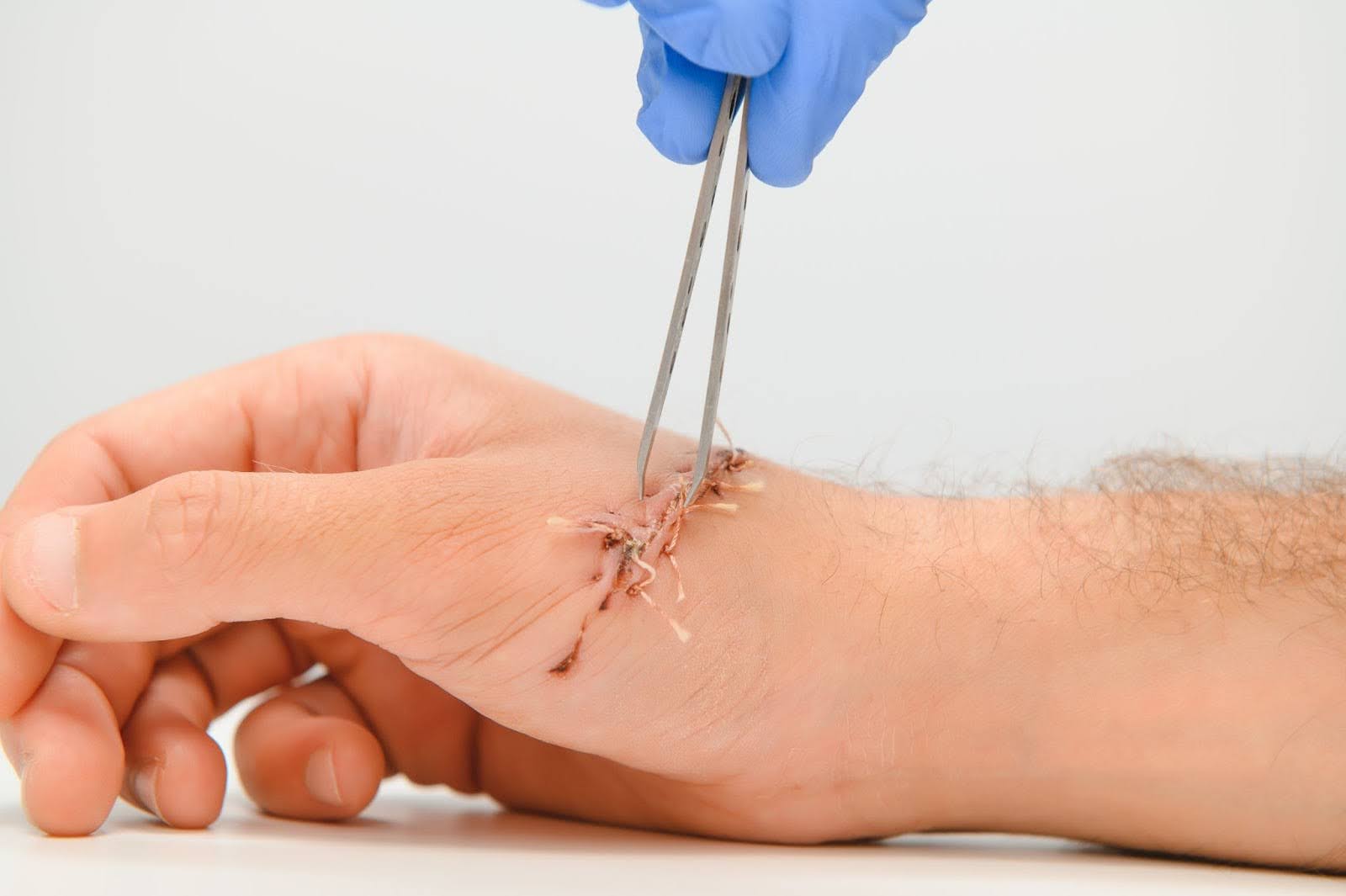 A doctor sutures a wound to prevent dehiscence on a patient’s hand.