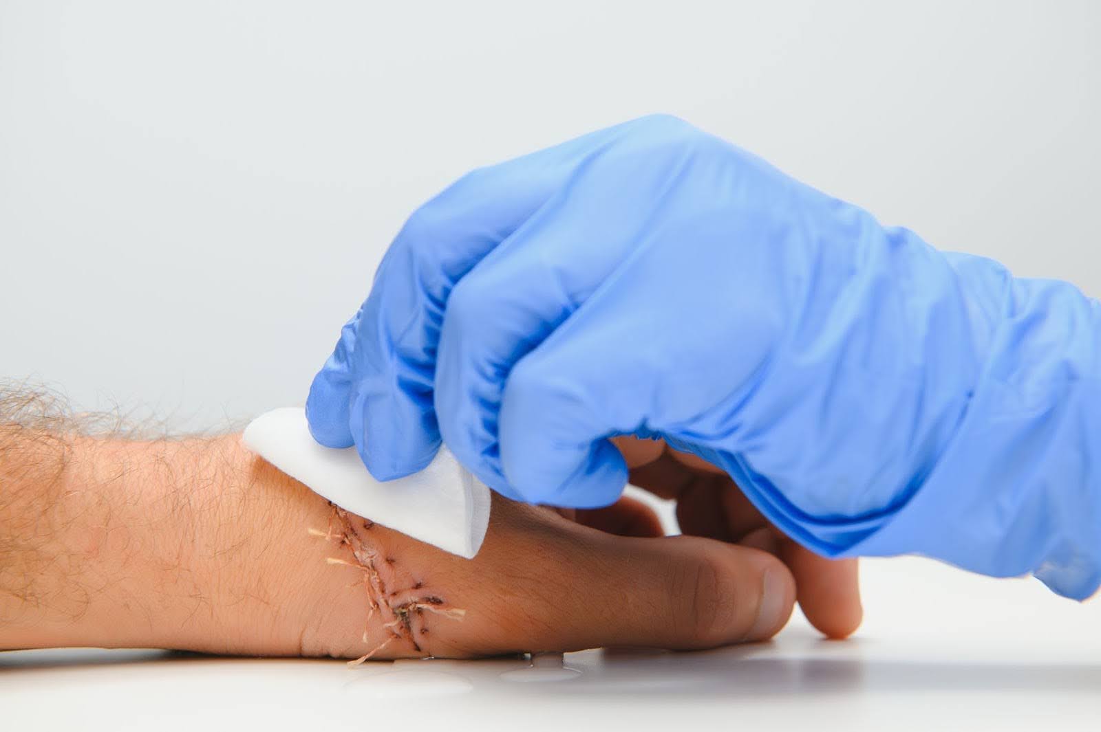 Cropped shot of a nurse’s hand cleaning a wound with a cotton ball and a dressing set during debridement.