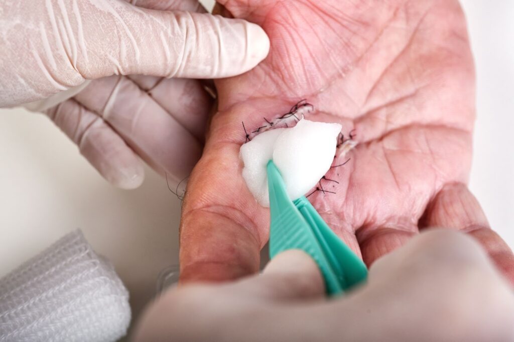 Cropped shot of a doctor cleaning a wound and applying the dressing after hand surgery.