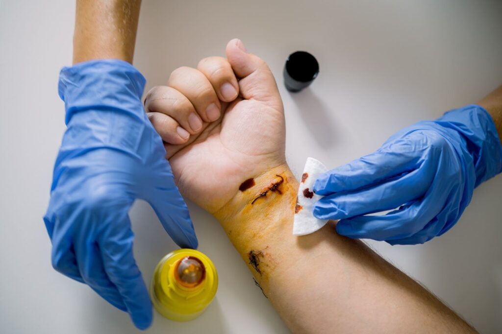 Cropped shot of a doctor applying antiseptic to the patient’s wounded wrist.
